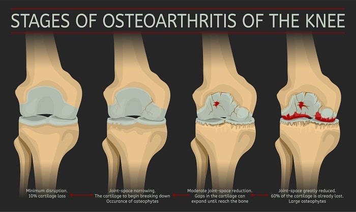 osteoarthritis